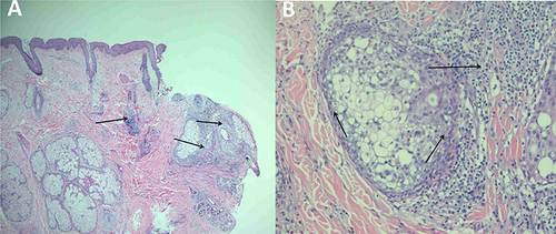 Figure 2 (A) The image displays hyperkeratosis, with lamellar mixed inflammatory cell infiltration (indicated by black arrows) in the superficial dermis (HE, 40× magnification). (B) The image reveals dense lymphocytic and eosinophilic infiltration (indicated by black arrows) around hair follicles and sebaceous glands, disrupting some structures (HE, 200× magnification).