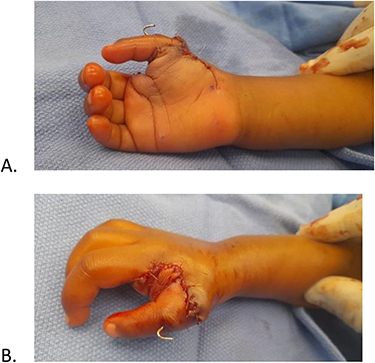 Figure 5 Postoperative skin perfusion: (A) palmar and (B) dorsal aspect.