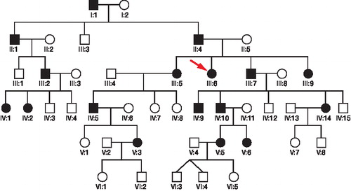 Figure 1.  Pedigree of the 6-generation family showing the 17 members affected by multiple epiphyseal dysplasia. Black symbols represent affected individuals. An arrow indicates the proband.