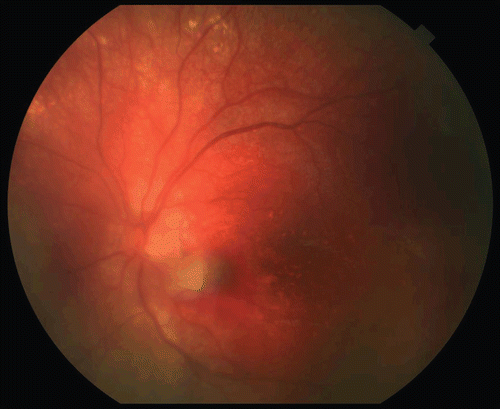 FIGURE 2  Fundus picture showing left macular hemorrhage with pigment epithelial detachment.