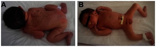 Figure 1 Dysmorphic features of patient described in this study. (A) Short webbed neck. (B) Large extremities, left talus valgus deformity, large penis and testes.