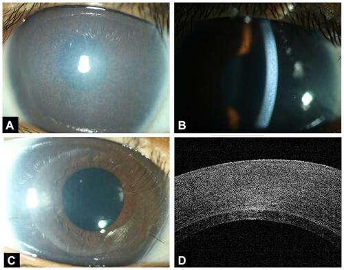 Figure 1 Pre- and Post-operative image of a CHED patient. (A and B) Diffuse and slit examination of the CHED patient using slit lamp bio-microscopy prior to surgery, (C) six-week post-DSAEK of the same patient with clear cornea, (D) ASOCT depicting a well attached graft to the host cornea.