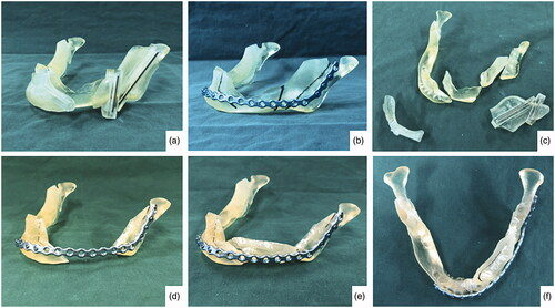 Figure 4. Picture on the upper left corner (a), fitting of the surgical guides; (b) pre-bending of reconstruction plate according to the contour of the 3D printed pre-operative mandible; (c) the 3D printed mandible was cut according to the guides; (d) temporary fixation of the reconstruction plate to the mandible; (e and f) fitting of the anterior ramus graft.
