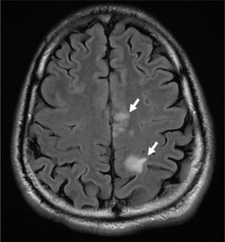 Figure 1 Multifocal T2 magnetic resonance image showing high signal intensity noted in parasagittal left frontoparietal region; there is intense punctuate enhancement post-gadolinium contrast (white arrows).