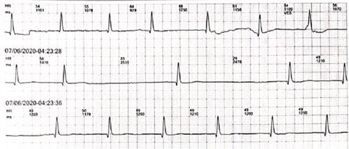 Figure 1 Admitted ECG showed significant sinus bradycardia and sinus arrest.