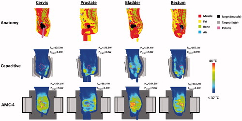 Figure 15. Sagittal slices of the simulated temperature distribution for small cervix, prostate, bladder and rectum cancer patients heated with capacitive electrodes using overlay boluses or the radiative AMC-4 system. Electrode sizes top + bottom were 25 + 25 cm (cervix, prostate, rectum) and 15 + 25 cm (bladder). The maximum temperature in all distributions is 44 °C. The total power absorbed in the patient (Ptot) and in the target region (Ptarget) is indicated for each distribution. Slices were taken approximately through the centre of the patient. The contour in the temperature distributions indicates the target region.
