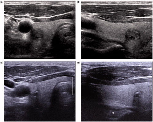 Figure 4. (A–D) Gradual reduction and resultant calcified residues of papillary thyroid carcinoma after radiofrequency ablation. (A and B) Transverse and longitudinal ultrasonography of a 79-year-old man revealed an 11-mm mass proven as a papillary thyroid carcinoma on-fine needle aspiration in the right thyroid gland. (C and D) At 4-year follow-up after radiofrequency ablation, transverse and longitudinal ultrasonography revealed a 3-mm calcified residue in the ablation zone. At 3 year, fine-needle aspiration and core-needle biopsy of the ablation zone revealed no tumour cells (results not shown).