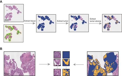 Figure 1 Image preprocessing. (A) The process of extracting tumor stroma. (B) The tumor stroma and corresponding mask were dissected into patches (512×512 pixels).