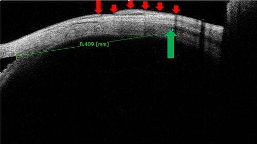 Figure 6 A resected medial rectus muscle, the muscle specific hypoechoic area is present at 8.4 mm (green arrow). Again, the anterior ocular coat prior to original insertion is regular (left to large red arrow), whereas the posterior ocular coat shows a variable thickness with conjunctival scarring (small red arrows).