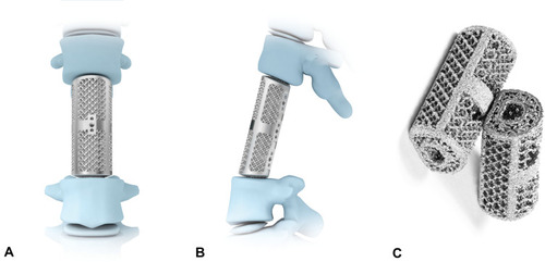 Figure 1 3D-printed artificial vertebral body: oblique (A), lateral (B), and superior (C) views.