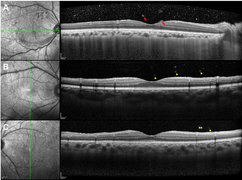 Figure 2 Representative cases with infectious uveitis, noninfectious granulomatous uveitis, and noninfectious nongranulomatous uveitis. (A) Numerous hyperreflective particles and few aggregated particles clots (red arrows) are shown in the horizontal OCT image, with cytomegalovirus retinitis as a cause of infectious uveitis. (B) Scattered vitreous particles and moderately sized particles without aggregating particles (yellow arrow heads) are observed in the vertical OCT image, with sarcoidosis as the cause of noninfectious granulomatous uveitis. (C) A few vitreous small particles (yellow arrow heads) are seen in the vertical OCT image, with psoriasis as a cause of noninfectious nongranulomatous uveitis.