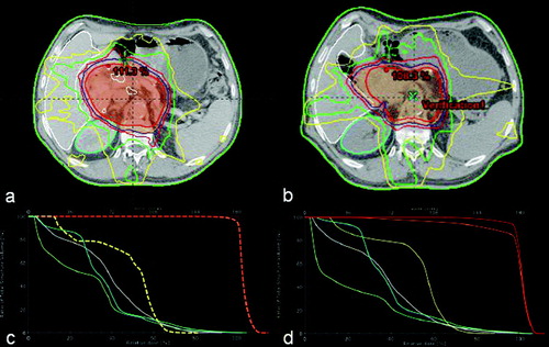 Figure 3.  Target volumes and organs at risk delineation at the level of clinical relevant operative clips based on simulation (a) and re-simulation with no re-optimization (b) CTs, as well as comparative DVHs (c and d corresponding to original simulation and re-simulation CTs, respectively). PTV is orange-colored, GTV red, and spinal cord yellow, right kidney teal, and left kidney pale green.