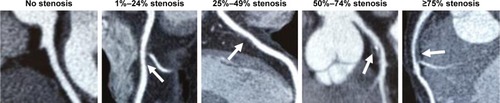 Figure 1 Visual quantitative grading of coronary artery stenosis using coronary computed tomography angiography. The severity of coronary artery stenosis (arrows) was visually categorized as no stenosis, 1%–24% stenosis, 25%–49% stenosis, 50%–74% stenosis, and ≥75% stenosis. Patients with at least one coronary artery stenotic lesion ≥75% were considered to have significant coronary artery stenosis.