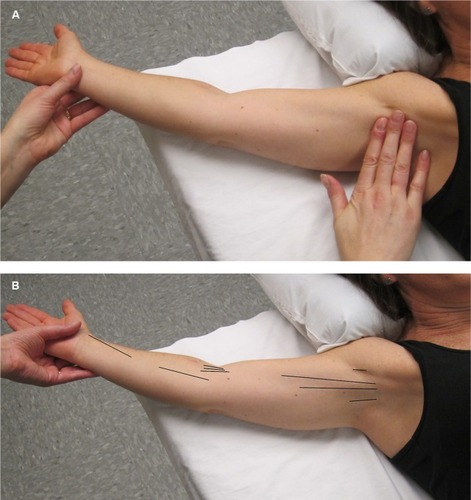 Figure 3 (A) In order to make an accurate diagnosis of the presence or absence of AWS. The physical examination should be performed in a manner that is designed to facilitate the search for the problem. The first step is to gently but maximally extend the arm at the elbow and then gently but maximally abduct the affected arm at the shoulder. The person performing the evaluation both visualizes and palpates for cords in the locations indicated in (B). (B) This figure illustrates the locations (see black lines) in which a cord or cords may be found, including the axilla, down the upper arm from the axilla to and across the antecubital space, and rarely down the forearm to the base of the thumb.