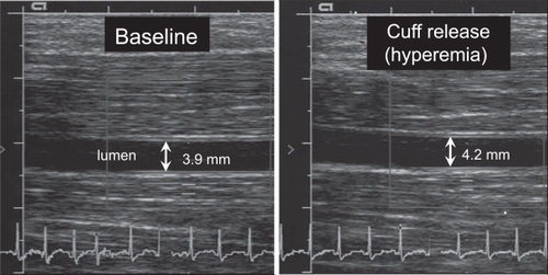 Figure 2 High-resolution ultrasound images showing the brachial artery before (left) and after (right) arterial occlusion.
