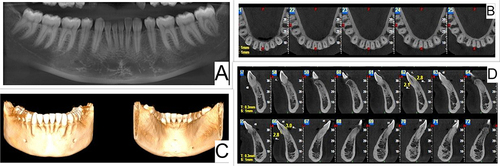 Figure 2 OPG and CBCT images showing minimal bone loss in the labial plate beneath the gingival overgrowth (A–D).