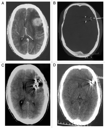 Figure 2. A 68-y-old male patient with recurrent gliomas. (A) CT images before 125I seed implantation treatment showed that brain tumor of left anterior parietal region was 25 mm × 30 mm × 40 mm. (B) needle insertion during 125I seed implantation operation. C:two months after 125I seed implantation treatment. (D) one year after 125I seed implantation treatment.