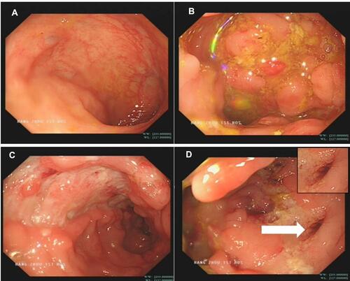Figure 1 Colonoscopy. (A) The mucosa of the terminal ileum and appendiceal orifice were normal. (B and C) The colonic mucosa showed paving stone-like changes and ulcers. (D) The rectal fistula was 25 cm away from the anus. The white arrow in the picture indicates the rectal fistula.