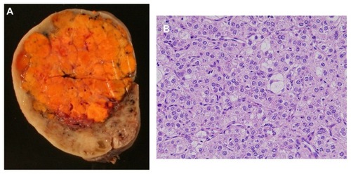Figure 1 Resected specimen. (A) Macroscopic findings. The tumor was an orange-colored solid mass. (B) Microscopic findings.