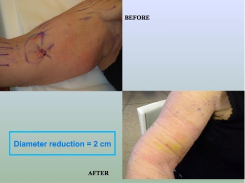 Figure 3 Two-cm reduction in right arm circumference after first treatment with Nd:YAG 1062 nm (15 W) endovenous laser.