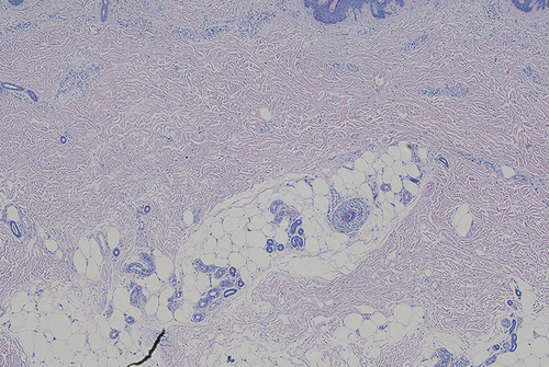 Figure 6 The narrow vascular spaces separated by reticular dermal collagen bundles in the dermis. (Hematoxylin-eosin stain; original magnifications: B, × 4).