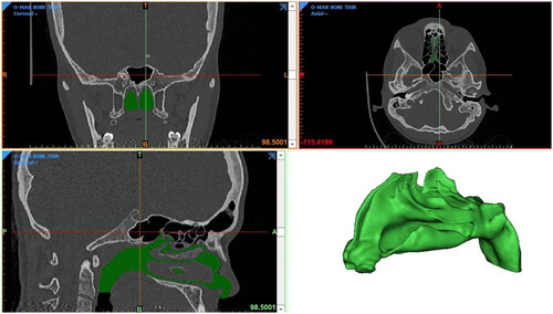 Figure 1. Coronal and sagittal views with the generated 3D nasal cavity model.