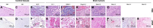 Figure 1 Immunohistochemical evaluation of uPAR expression in control canine brain tissues (A–F) and brain tumors (G–R).