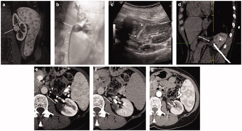 Figure 1. Treatment of a left kidney central tumor with renal sinus extension with image-guided microwave ablation and retrograde pyeloperfusion. (a) T1-weighted, fat-saturated, contrast-enhanced MR image demonstrating a centrally located tumor (white arrow) with extension in close proximity of the renal sinus. (b) Retrograde pyeloperfusion was performed through a single j stent (white arrowheads) placed endoscopically the day of the ablation with the tip located in the renal pelvis (white arrow). (c) Microwave antenna (white arrowheads) was inserted under real-time US visualization. (d) CT confirmed the precise positioning of the microwave antenna at the level of the tumor. (e, f) Contrast-enhanced CT 6 months after treatment demonstrates the correct ablation of the tumor (white arrows) with no residual enhancing tumor either in the arterial phase (e, white arrowhead = arterial branch) or the excretory phase (f, white arrowhead = renal calyx). (g) Contrast-enhanced CT in the arterial phase 12 months after the ablation demonstrating complete ablation with tumor shrinkage (white arrow) and no complications.