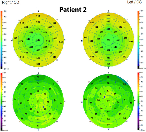 Figure 3 OCT pachymetry and ETM demonstrating normal epithelial thickness OU.