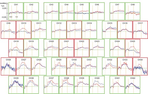 Figure 1 Grand-average waveforms of changes in oxygenated hemoglobin concentration in controls (red line) and the group with obsessive-compulsive disorder (blue line). The areas enclosed with red frames show the regions of interest. The x-axis shows time course (s) and the y-axis shows the change in oxygenated hemoglobin concentration (mM • cm). Grand-average waveforms of changes in oxygenated hemoglobin concentration in healthy controls increased during the task period, but did not increase markedly in the obsessive-compulsive disorder group.