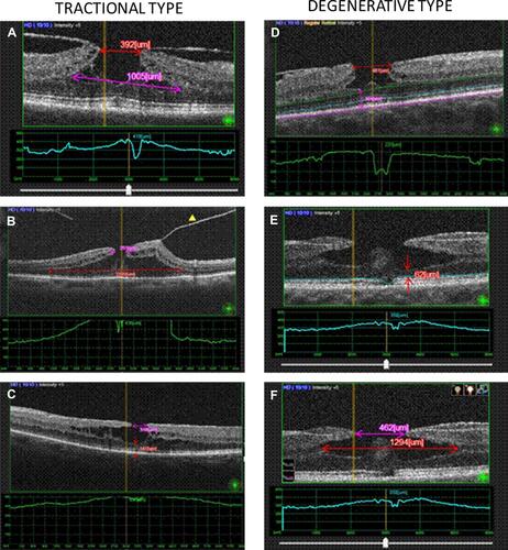 Figure 1 Structural features of the lamellar macular hole types (tractional vs degenerative) studied by optical coherence tomography. Representative images of the tractional type are shown: (A) the callipers show the following measurements - Purple: base size of the hole; Red: top size of the hole. The schisis of the retinal layers is visible from the multiple narrow hyperreflective tissue bridges crossing the intraretinal splitting; (B) A tractional LMH with posterior vitreous detachment (yellow triangle), intraretinal cavities, sharp splitting edges, and EZ continuity are shown in the “moustache”-like morphology; (C) The traction of the ERM on the top of retina pulls the edges antero-lateral, thus splitting the retinal layers into a lamellar macular hole. The purple calliper measures the top size of the hole, while the red calliper measures the MFT. Representative images of the degenerative type are shown: (D) A round-edged cavitation, with a foveal bump and epiretinal proliferation is detected in the “top hat” morphology. The MFT was measured manually using a calliper (Purple), as the thinnest vertical distance from the base of the LMH down to the Bruch’s membrane. Horizontal lines - purple: Bruch’s membrane, blue: Ellipsoid Zone (EZ); green: Outer Nuclear Layer (ONL); (E) Round-edged cavitation, with a foveal bump, and EZ disruption (blue horizontal line); MFT (red); (F) the callipers show the following measurements - Purple: top size of the hole; Red: base size of the hole.