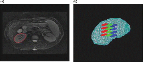 Figure 4. (a) The kidney region delineated on an MR image. (b) 3D visualization of therapy targeting fractions. The red, green and blue regions represent three different targeting fractions.