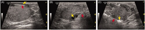 Figure 1. US imaging of hydro-dissection technique. (A–B) The fluid (yellow arrow) was firstly infused between BBL and skin (A), between BBL and pectoralis (B) by the fine needle (red arrow). (C) After hydro-dissection was successfully performed, the MW antenna was placed into the BBL bottom (red arrow). Then hyper-echogenicity gradually increased from the irradiating segment of the antenna (yellow arrow) at the beginning of the MWA session.