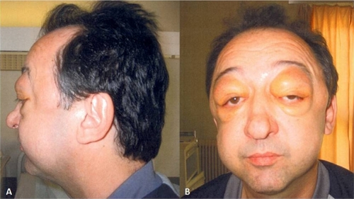 Figure 1 Extensive eyelid swelling combined with less obvious swelling of the temples and cheeks.