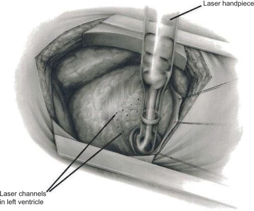 Figure 1 Illustration showing left thoracotomy and exposure of the heart for TMR.