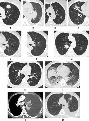Figure 3 Computed tomography images demonstrating the morphological classification of lung adenocarcinoma. Representative axial images of (A) Type I, showing a peripheral solid nodule with lobulation and pleural retraction in the left upper lobe; (B) Type II, showing a central solid mass in the left hilum with bronchiostenosis of the left upper lobe; (C) Type III, showing a subsolid nodule with irregular margin in the left upper lobe; (D) Type IV, showing focal triangular consolidation with bronchial leafless tree sign and pleural retraction in the right middle lobe; (E) Type V, showing a cystic airspace with irregular margins, septation, nonuniform cyst wall, and ground-glass opacity in the left upper lobe; (F) second image of (E) taken 45 months later showing an increase in lesion size with thickening of the cyst wall and increased ground-glass opacity; (G) Type VI in a 60-year-old male showing a solid nodule in the right upper lobe and a subsolid nodule in the left upper lobe which were surgically confirmed as adenocarcinoma; (H) Type VI in a 75-year-old male showing a solid nodule and a cystic airspace in the left lung which were surgically confirmed as adenocarcinoma; (I) Type VII, showing multiple consolidations and ground-glass opacity in both lungs with deadwood-like air bronchogram (black arrow) and air space (black arrowhead); (J) Type VIII, showing left massive pleural effusion with atelectasis in which the tumor was embedded, resulting in heterogeneous enhancement (white arrow), adenocarcinoma cells were found by cytological examination of the hydrothorax; (K) Follow-up imaging of (J) revealed the presence of a solid nodule (ie, a tumor) in the left upper lobe with partial absorption of the hydrothorax after two cycles of chemotherapy.