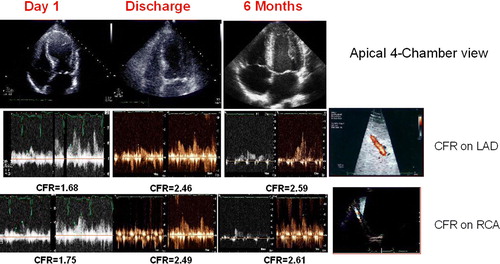 Figure 1.  Transthoracic echocardiography: time course of left ventricular four-chamber view (top) and Doppler-derived coronary flow reserve (CFR) on left anterior descending coronary artery (middle) and on right coronary artery (bottom) at day 1 (acute phase), at discharge, and 6 months after discharge. Top: end-systolic frame showing a large akinetic apex at admission (rest WMSI) and improving at discharge (rest WMSI), with complete recovery of regional function after 6 months (rest WMSI). Middle panel: coronary flow velocity profile at base-line and after dipyridamole on LAD at each time point as for wall motion score index (WMSI). Bottom panel: coronary flow velocity profile at base-line and after dipyridamole on right coronary artery at each time point as for WMSI.