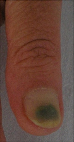 Figure 2 Onycholysis and secondary Pseudomonas aeruginosa infection of the finger nail in a 68-year-old man.
