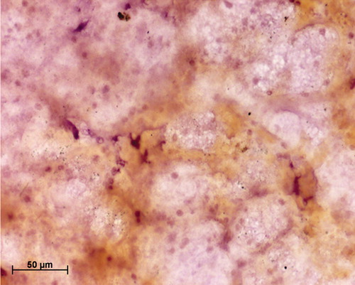 Figure 3. Immunocytochemical staining of cervical smear with proliferating cell nuclear antigen (PCNA) antibody using the standard protocol; note the poor visibility of the PCNA-positive cells due to the presence of mucus.