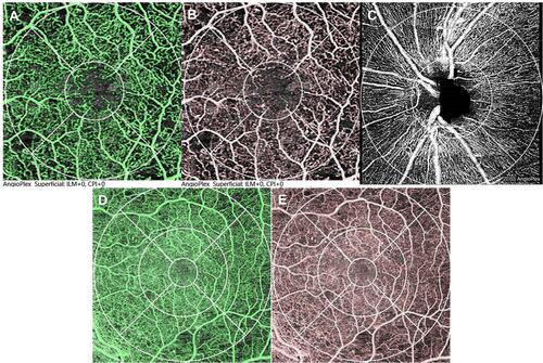 Figure 1 Optical coherence tomography angiography (OCT-A) images. (A) OCT-A 3 mm x 3 mm scans showing vascular perfusion (VP) (green pixels) in superficial capillary plexus (SCP). The grid shows center (1 mm diameter circle, centered in fovea) and perifoveal ring (1 mm to 3 mm from fovea). (B) OCT-A 3 mm x 3mm scans showing vascular density (VD) (red lines, (B) SCP. The grid shows center (1 mm diameter circle, centered in fovea) and perifoveal ring (1 mm to 3 mm from fovea). (C) OCT-A 4.5 mm x 4.5 mm scan showing VP (white pixels) in peripapillary capillary plexus. The grid shows peripapillary ring (1.5 mm to 4.5 mm from disc center). (D) OCT-A 6 mm x 6 mm scans showing VP (green pixels) in deep capillary plexus (DCP). The grid shows center (1 mm diameter circle, centered in fovea), perifoveal ring (1 mm to 3 mm from fovea) and parafoveal ring (3 mm to 6 mm from fovea). E. OCT-A 6 mm x 6 mm scans showing VD (red lines, (E) in deep capillary plexus (DCP). The grid shows center (1 mm diameter circle, centered in fovea), perifoveal ring (1 mm to 3 mm from fovea) and parafoveal ring (3 mm to 6 mm from fovea).