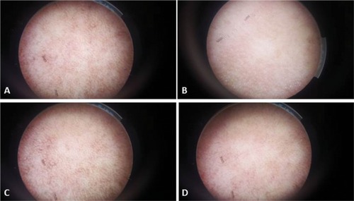 Figure 3 Dermoscopic photomicrographs of melasma lesions shows a fine brown reticular pattern superimposed on a background of faint light brown areas (original magnification ×15): (A) at baseline, (B) 12 weeks after starting treatment with fractional Er:YAG laser + HQ cream, (C) at baseline, and (D) 12 weeks after starting treatment with HQ cream alone.