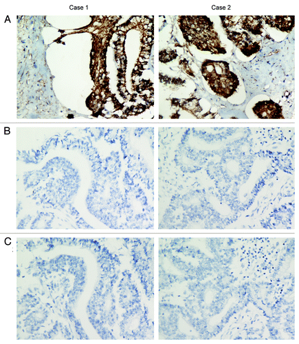 Figure 4. Immunohistochemical examination of two samples. (A) Both cases were strong positive for the β-catenin staining in the nuclei and cytoplasm. (B) CEA examination showed negative staining in two samples. (C) Negative staining of p53 in immunohistochemical examination. Representative photomicrographs are shown at the original magnification × 400.