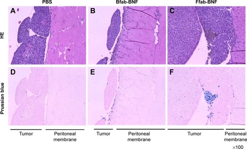 Figure 7 Histology of excised tumors from ovarian cancer model.Notes: Representative images where the tumor and peritoneal membrane are indicated. HE of tumor sections from animals treated with (A) PBS, (B) Bfab-BNF, or (C) Ffab-BNF. (D, E, F) Prussian blue staining of the same slides, respectively, to identify IONPs.Abbreviations: HE, hematoxylin eosin; PBS, phosphate-buffered saline; fab, an engineered monoclonal antibody fragment; Ffab, Farletuzufab, engineered from monoclonal antibody Farletuzumab; Bfab, Botulifab anti-botulinum toxin fab fragment; IONPs, iron oxide nanoparticles; BNF, bionized nanoferrite.