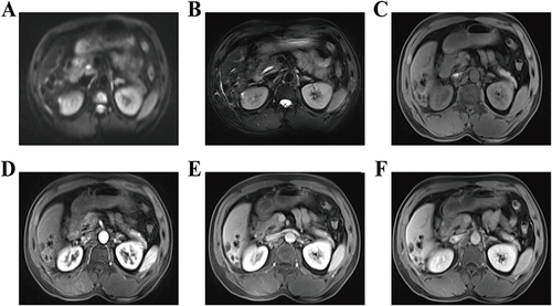 Figure 7 Magnetic resonance imaging showing the Multiple patchy nodules of different sizes were seen on S 5/6/7 in segment V of liver, (A) Diffusion-weighted imaging; (B) T1-weighted image; (C) T2-weighted image; (D) arterial phase; (E) portal phase; (F) equilibrium period.