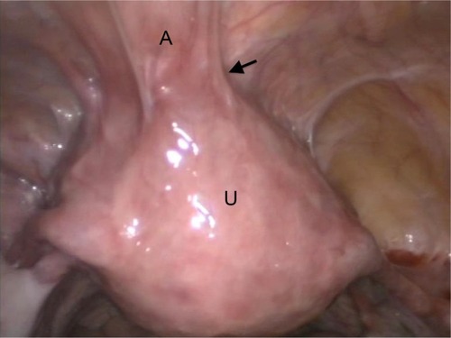Figure 2 Laparoscopic view of ventrofixed uterus of another case who underwent LAVH.