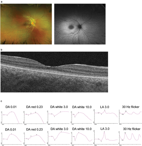 Figure 2b. Ophthalmological phenotype (Patient III-2). (a): fundus images and (b): OCT shows increased autofluorescence signal in the posterior pole and disruptions in the outer nuclear layer corresponding to photoreceptors; (c): upper panel—full filed ERG presents reduced function of cone photoreceptors with preserved function of rod photoreceptors, lower panel—age-adjusted normative data.
