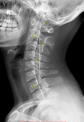 Figure 3 The schematic diagram for Borden’s method: A straight line drawn from the superior posterior edge of C2’s odontoid to the posterior inferior tip of the C7 vertebra is line A. Line B is a fitting curve along the posterior edges of all vertebral bodies. The longest vertical distance from line A to line B was measured representing cervical spine physiologic curve depth (line C). Scale bars (red line): 10 mm/segment.