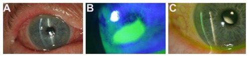 Figure 1 (A) Slit-lamp photograph of the right eye. Folds in Descemet’s membrane could be appreciated, as well as mucous discharge, conjunctival hyperemia, and surface irregularities. (B) Fluorescein staining reveals a large epithelial defect with numerous surrounding punctate epithelial erosions. (C) Six weeks later, there was nearly complete resolution of Euphorbia toxicity.