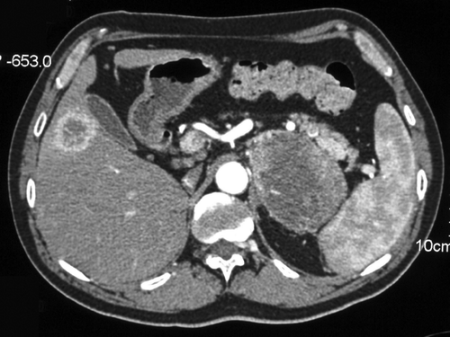 Figure 2.  Abdominal CT scan revealing a large left adrenal mass and liver metastasis.