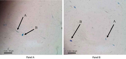 Figure 1. Aniline blue (AB) and toluidine blue (TB) staining assay for sperm chromatin integrity analysis. (A) AB staining assay for sperm chromatin integrity analysis. A: Sperms with mature chromatin appear with unstained head (AB-negative). Mature chromatin rich in cysteine residues, cannot bind AB dye; B: sperms with immature chromatin that are rich in lysine and arginine residues bind AB and appear with blue stained head (AB-positive). (B) TB staining assay for sperm chromatin integrity analysis. A: Sperms with good chromatin integrity. The phosphate groups of DNA strands in sperms with good chromatin integrity bind just a few TB dye molecules so that the sperms’ heads appear light blue (TB-negative); B: sperms with poor chromatin integrity. TB dye bind tight to the phosphate groups of DNA strands with of sperm chromatin with poor integrity resulting in dark blue (TB-positive) sperms’ heads. Magnification 1000x.